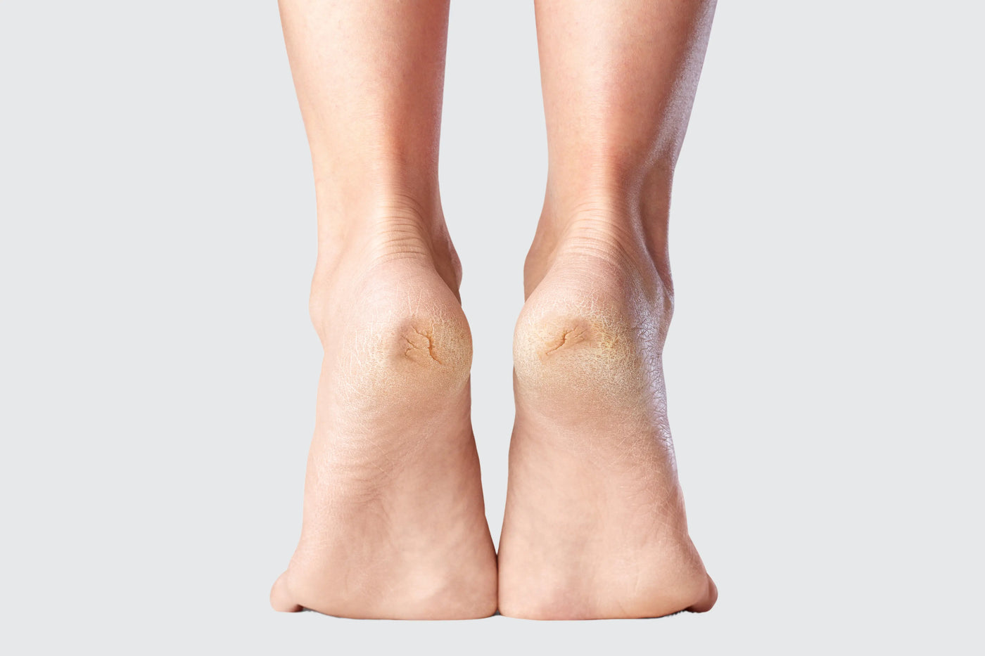 Gros plan sur une personne de dos sur la pointe des pieds, les deux talons concernés par des crevasses