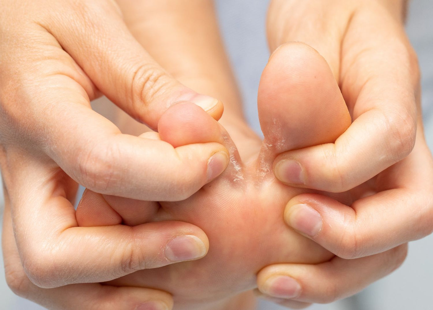 Gros plan sur une personne étirant deux orteils laissant apparaître une mycose avec desquamation