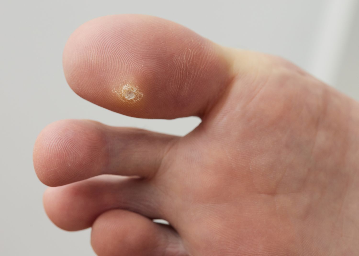 Comment enlever une verrue avec les remèdes de grand-mère ?