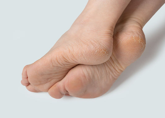 soigner crevasse pied