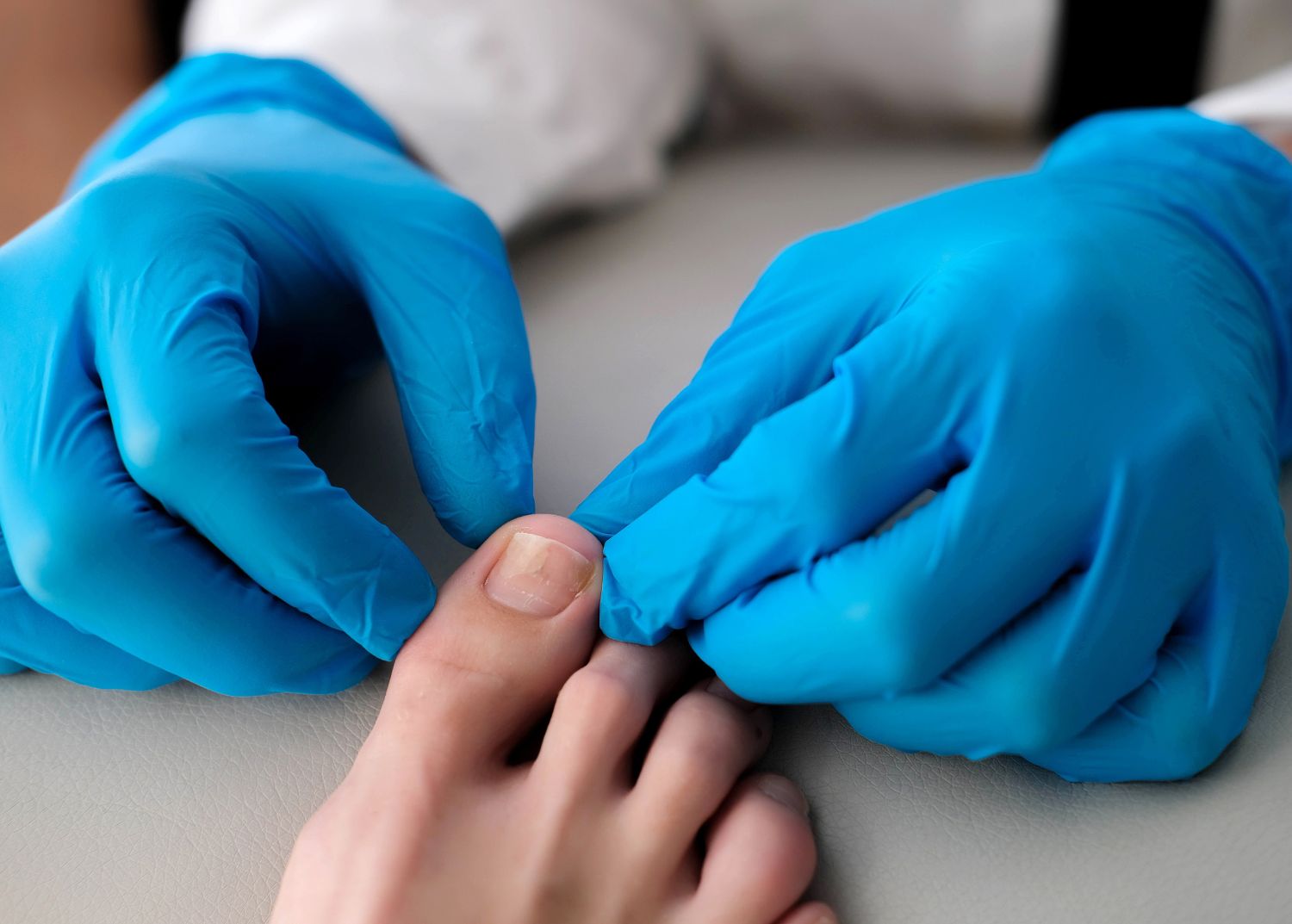 Gros plan sur les mains gantées d’un ou une professionnel de santé examinant un gros orteil concerné par une mycose