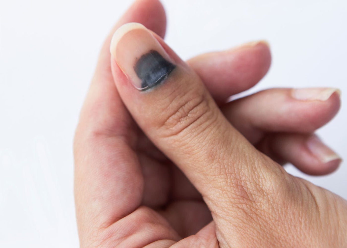 Gros plan sur un pouce dont la moitié de l’ongle est noire