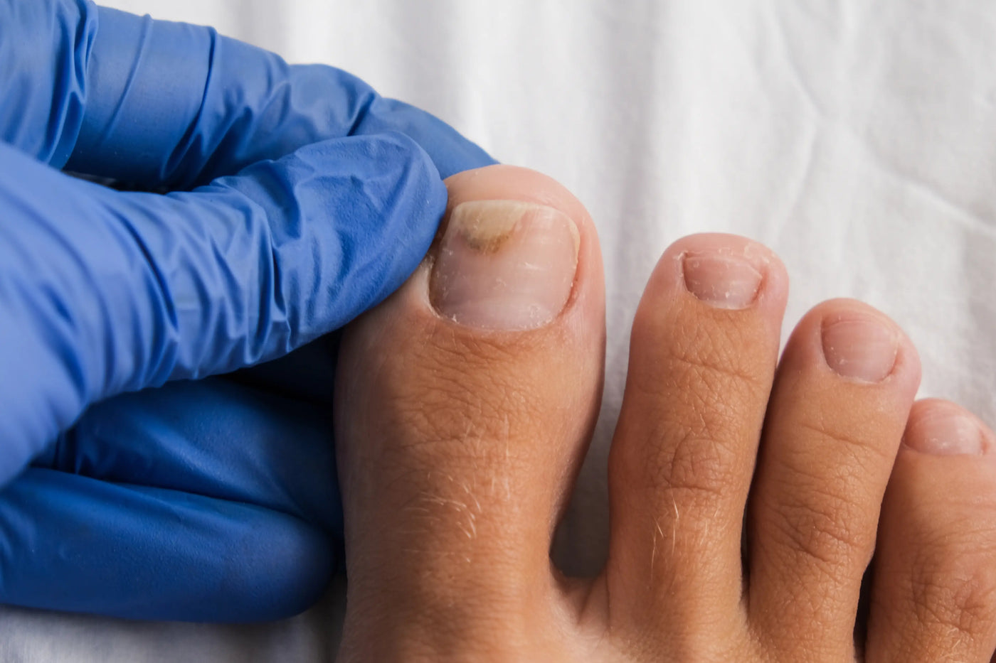 Mycose de l’ongle : définition, causes, symptômes et traitement