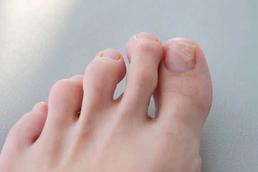Le Candida Albicans et son traitement