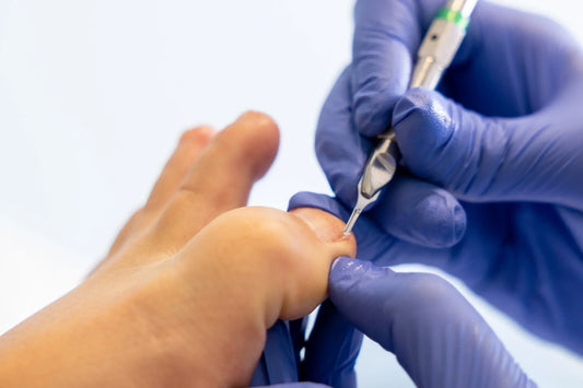 Gros plan sur la main gantée d’un podologue coupant une partie d’un ongle incarné