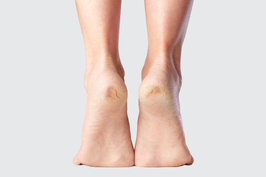 Gros plan sur une personne de dos sur la pointe des pieds, les deux talons concernés par des crevasses 