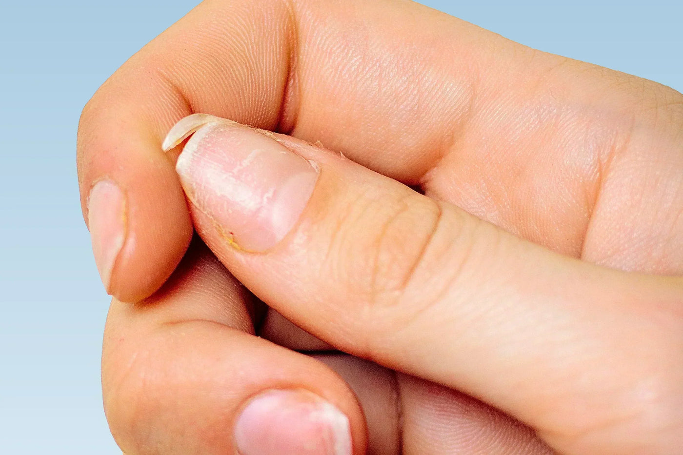 Ongle du pouce strié et fendu