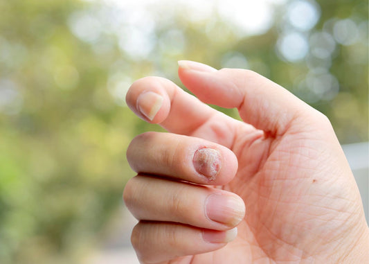 Mycose de l’ongle de la main : causes et traitements efficaces
