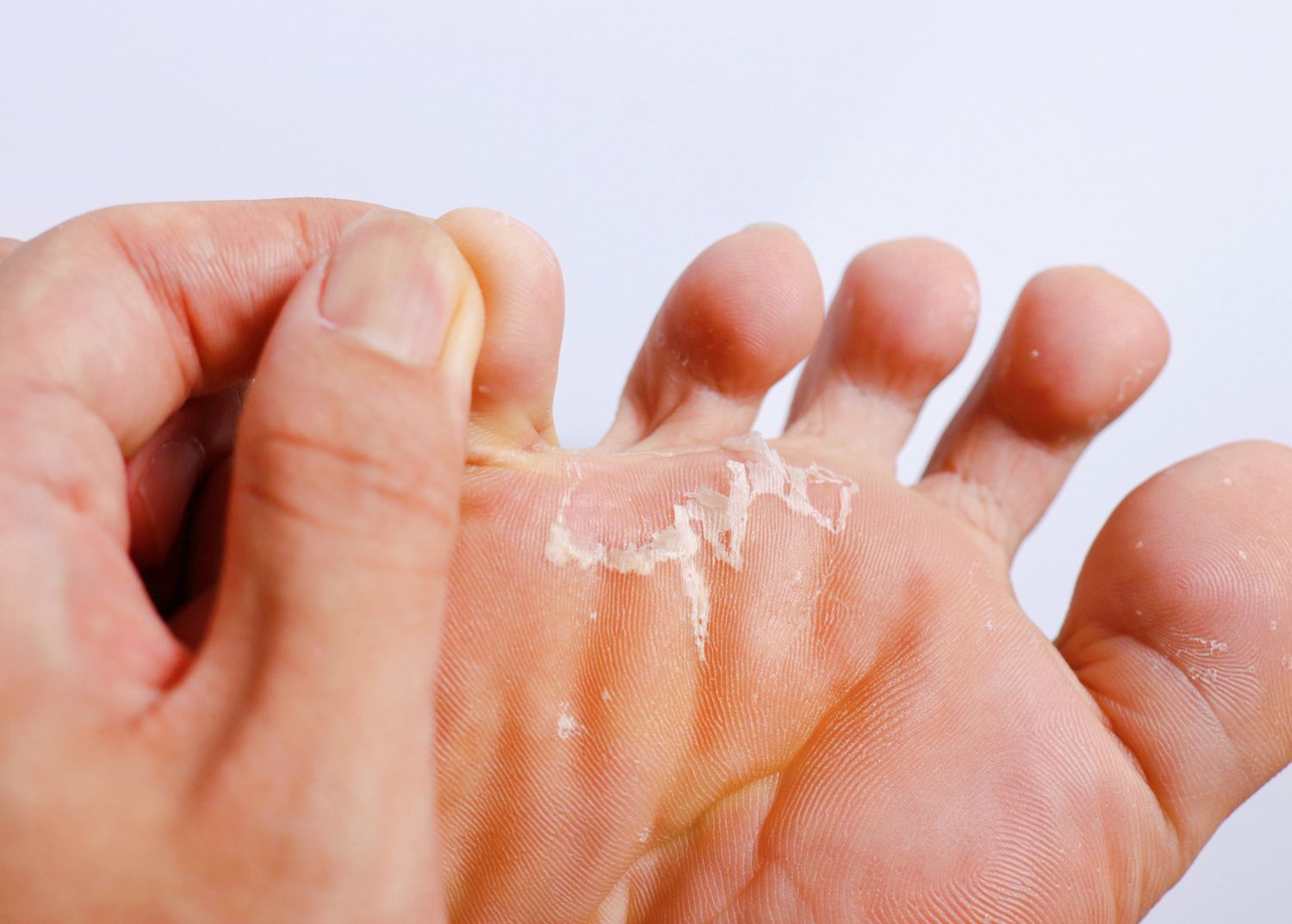 gros plan sur le derriere du pied avec une mycose du pied