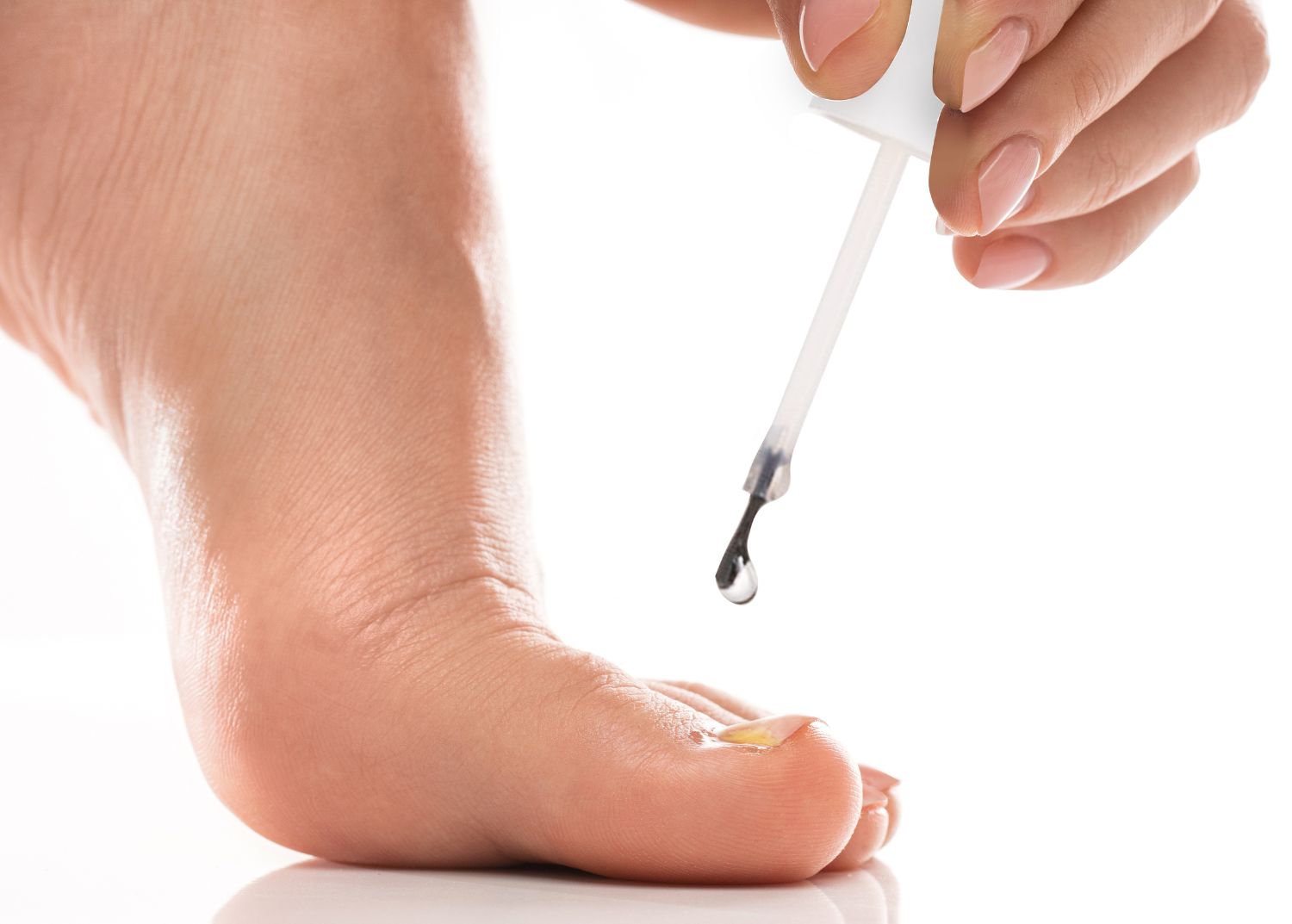 Gros plan sur la main d’une personne inspectant une mycose de l'ongle