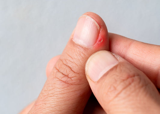  Gros plan sur un pouce souffrant de rougeur autour de l’ongle
