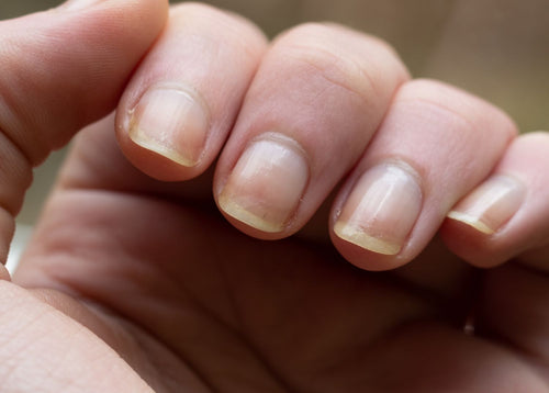 Gelbe Nägel: Unsere Tipps für die erfolgreiche Behandlung