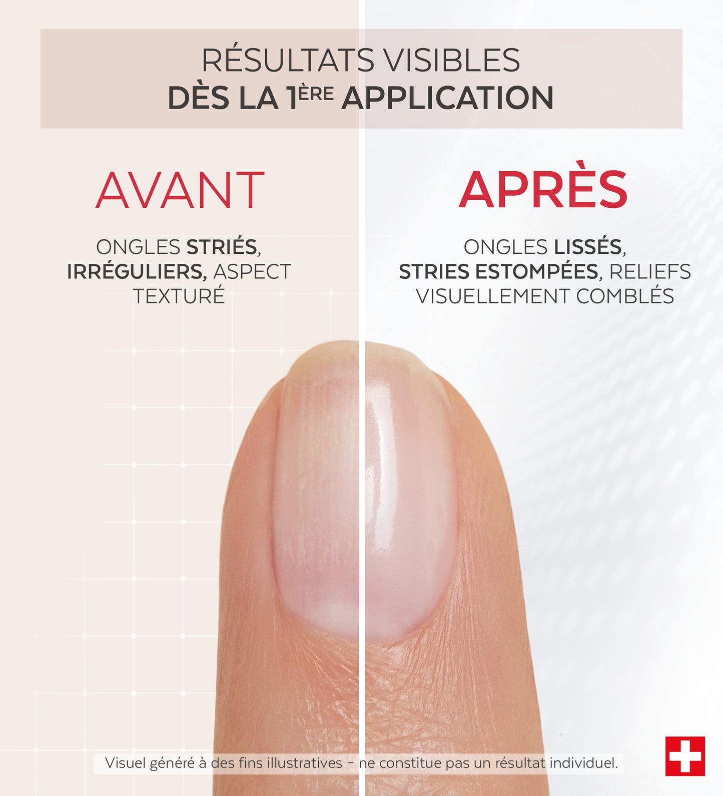 Résultats avant après du vernis Nail Corrector comblant collagène Poderm dès la 1ère application