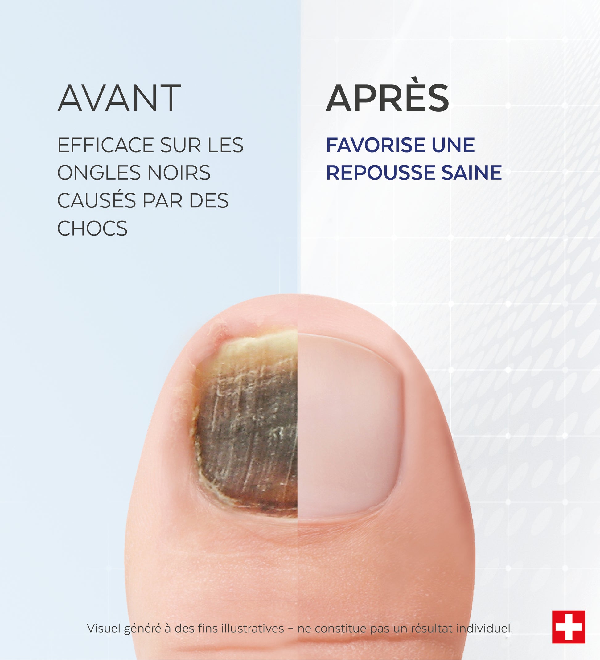 Sérum Ongles noirs, traumatisés