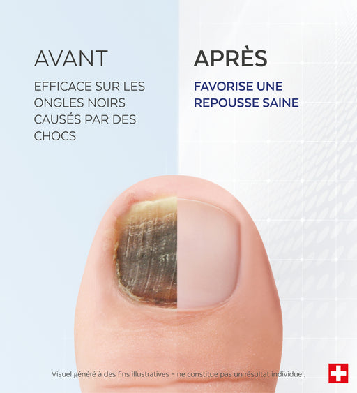 Sérum Ongles noirs, traumatisés