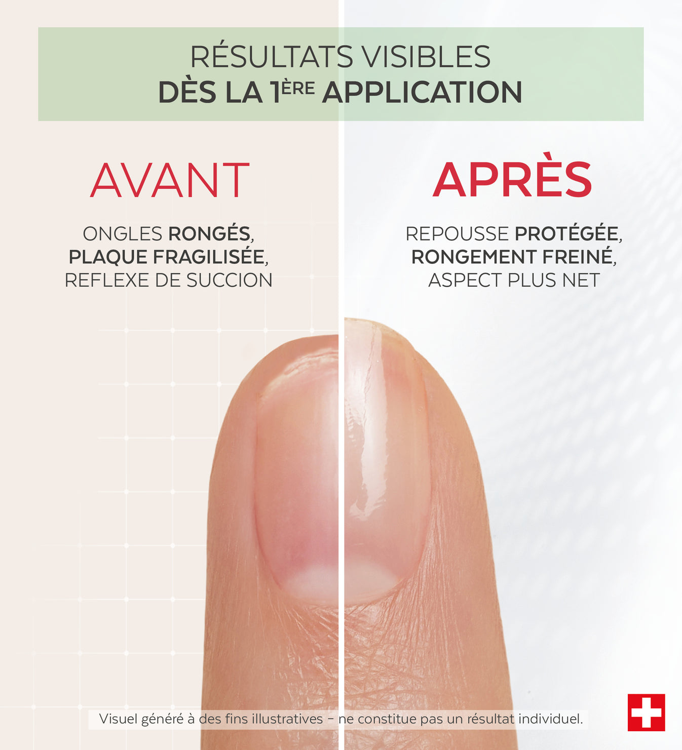 Résultats avant après du vernis Nail Corrector amer protéines de pois Poderm dès la 1ère application