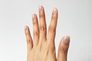 ongle et chimiotherapie