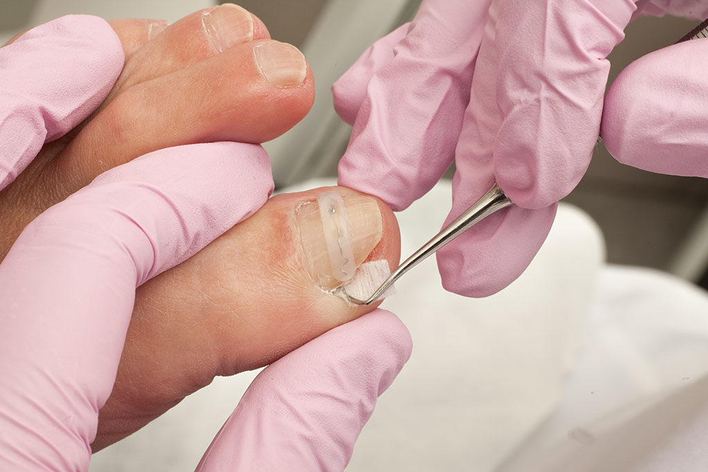 Fußpflegerin bei der Behandlung eines eingewachsenen Nagels