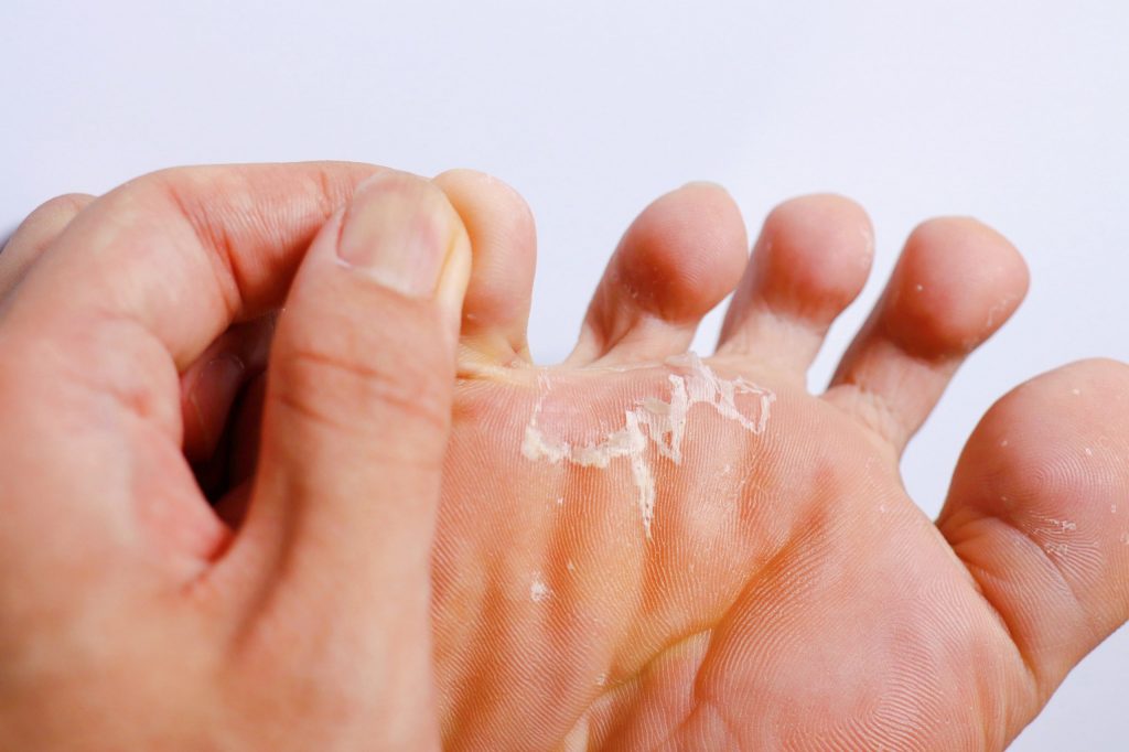 bicarbonate de soude pour mycose de pied 