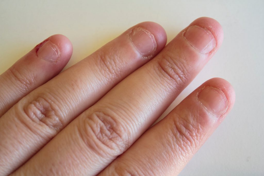 arrêter de se ronger les ongles avec l'homéopathie
