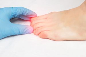 mycose ongle de pied douloureux