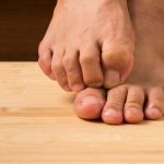 Chlorhaltiges Bleichmittel wird bei Fußpilz nicht empfohlen