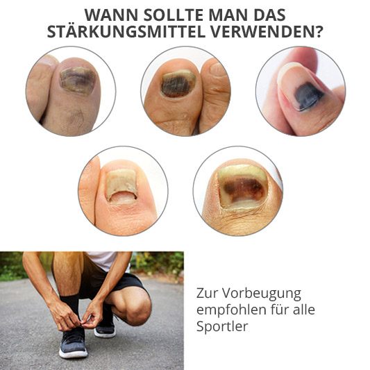 Beispiele für gestoßene Nägel. Serum FORTIFIANT von Poderm für Sportler.