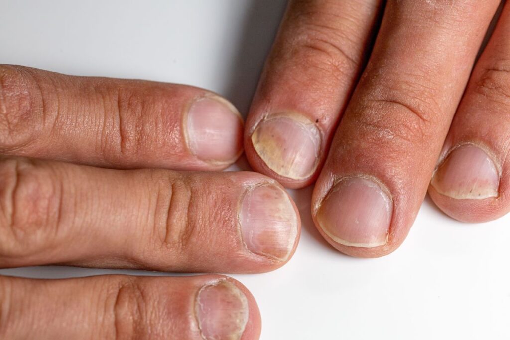 Psoriasis de l'ongle ou ongle jaune