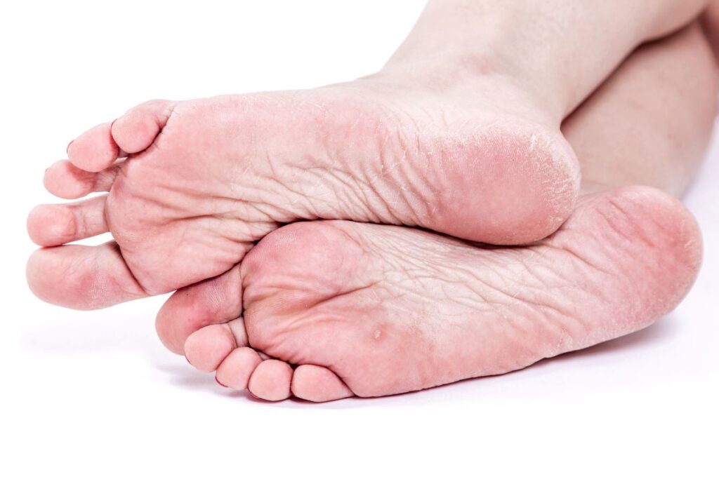 Trockene Füße: Welche Creme wählen?